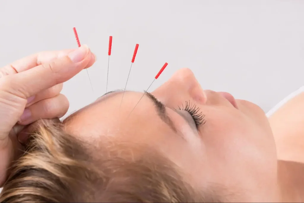 Acupuncture Benefits
