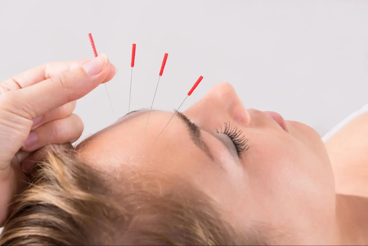 Acupuncture Benefits