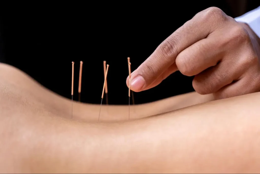 Best Acupuncture Near Me (2)