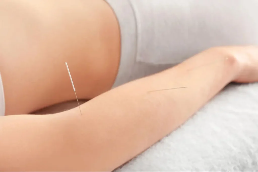 What is Acupuncture