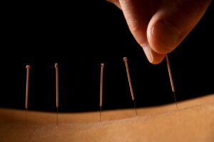 acupuncture for musculoskeletal pain winnipeg